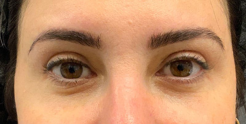 Blepharoplasty Before & After Gallery - Patient 156052 - Image 1