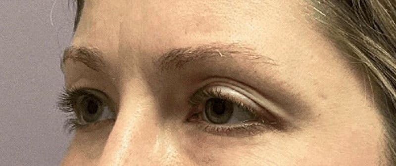 Blepharoplasty Before & After Gallery - Patient 732744 - Image 3