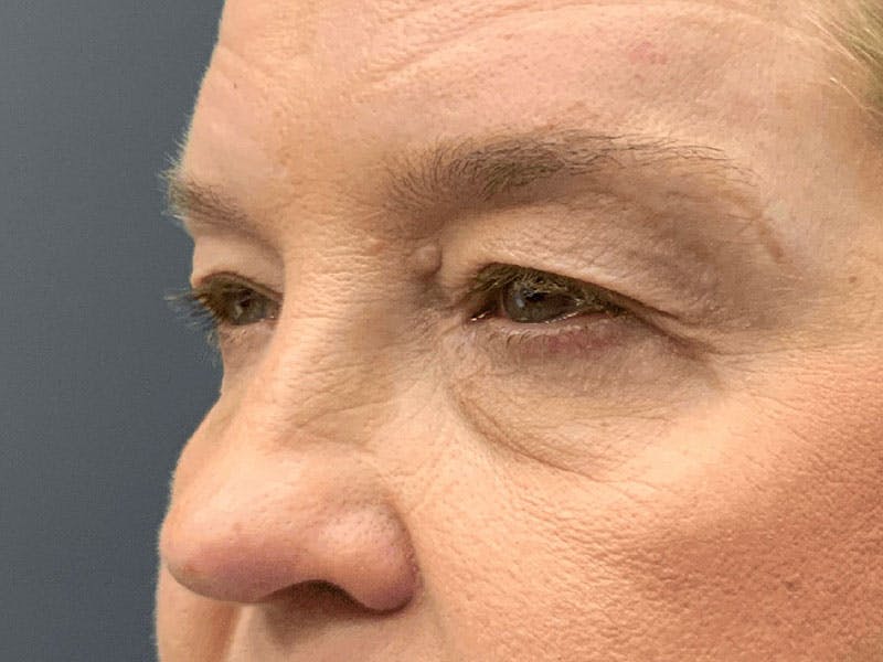 Blepharoplasty Before & After Gallery - Patient 290723 - Image 3