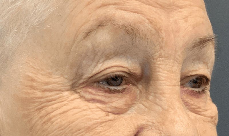 Blepharoplasty Before & After Gallery - Patient 355328 - Image 3