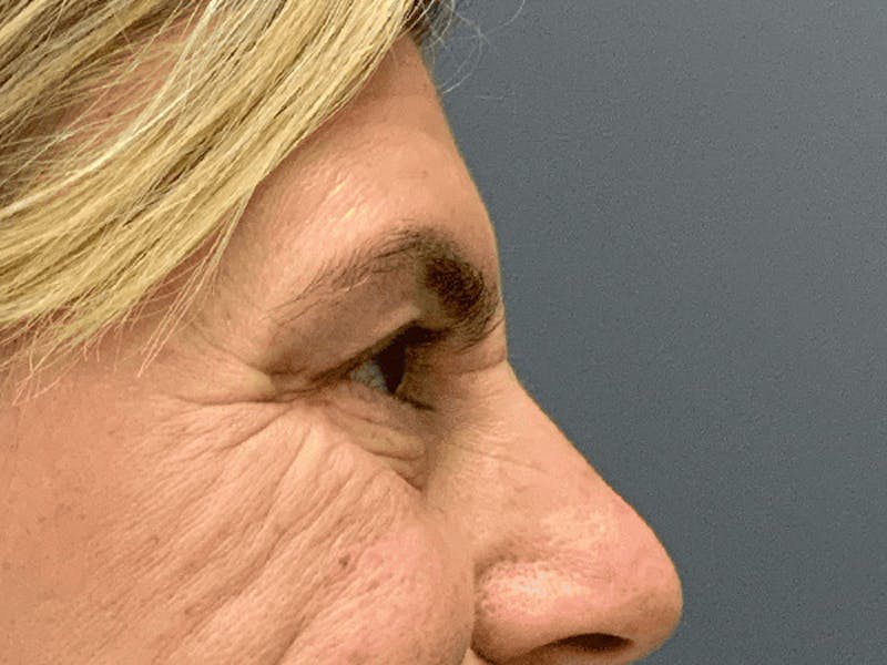 Blepharoplasty Before & After Gallery - Patient 296391 - Image 6