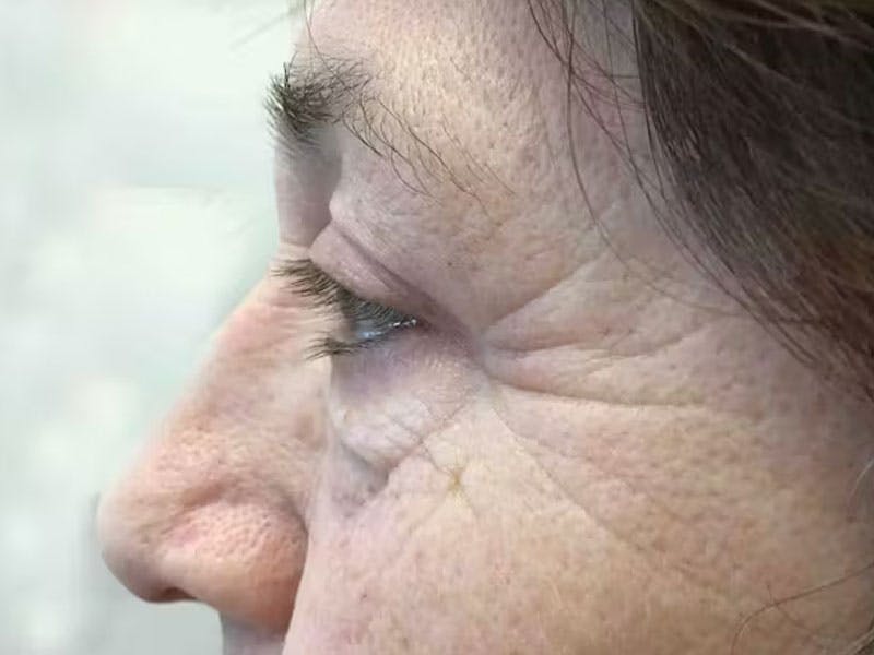 Blepharoplasty Before & After Gallery - Patient 187426 - Image 4