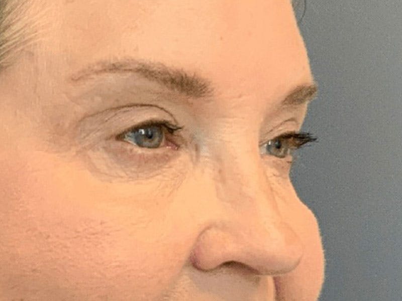 Blepharoplasty Before & After Gallery - Patient 290723 - Image 6
