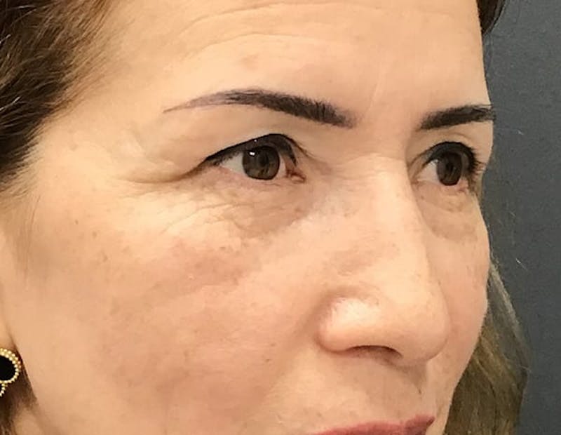 Blepharoplasty Before & After Gallery - Patient 368176 - Image 1