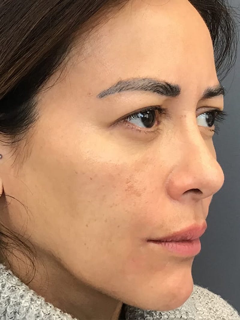 Dermal Fillers Before & After Gallery - Patient 976688 - Image 4
