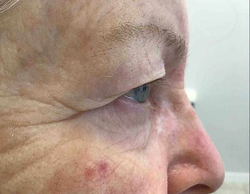 Blepharoplasty Before & After Gallery - Patient 288698 - Image 3