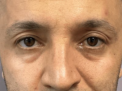 Blepharoplasty Before & After Gallery - Patient 278046 - Image 1