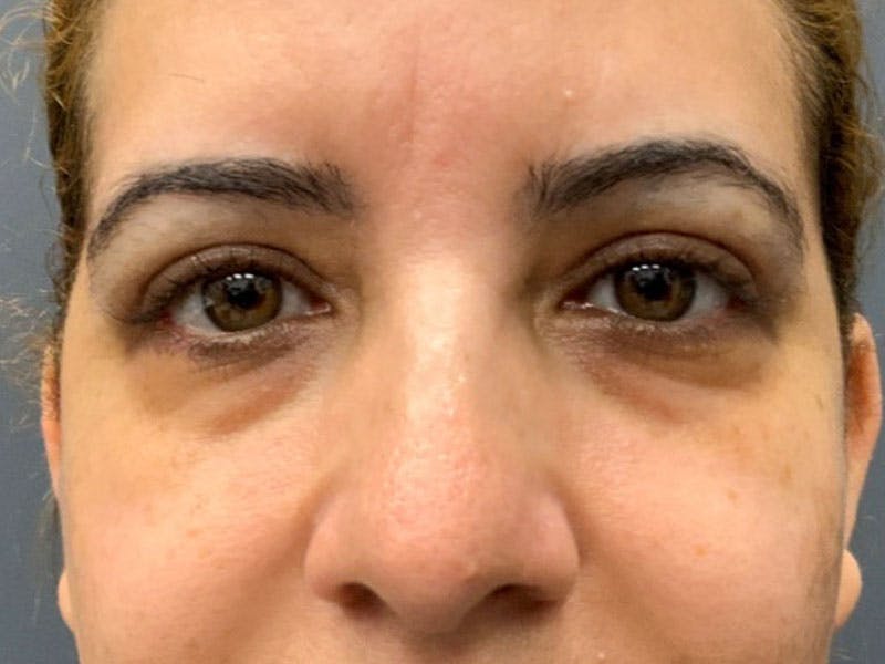 Blepharoplasty Before & After Gallery - Patient 246857 - Image 2