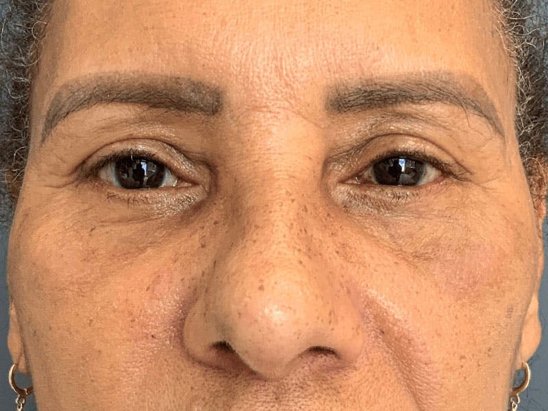Blepharoplasty Before & After Gallery - Patient 276694 - Image 2