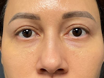 Blepharoplasty Before & After Gallery - Patient 410588 - Image 2