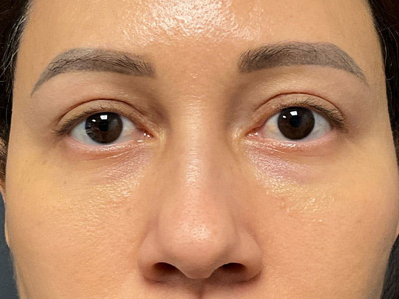 Blepharoplasty Before & After Gallery - Patient 410588 - Image 2