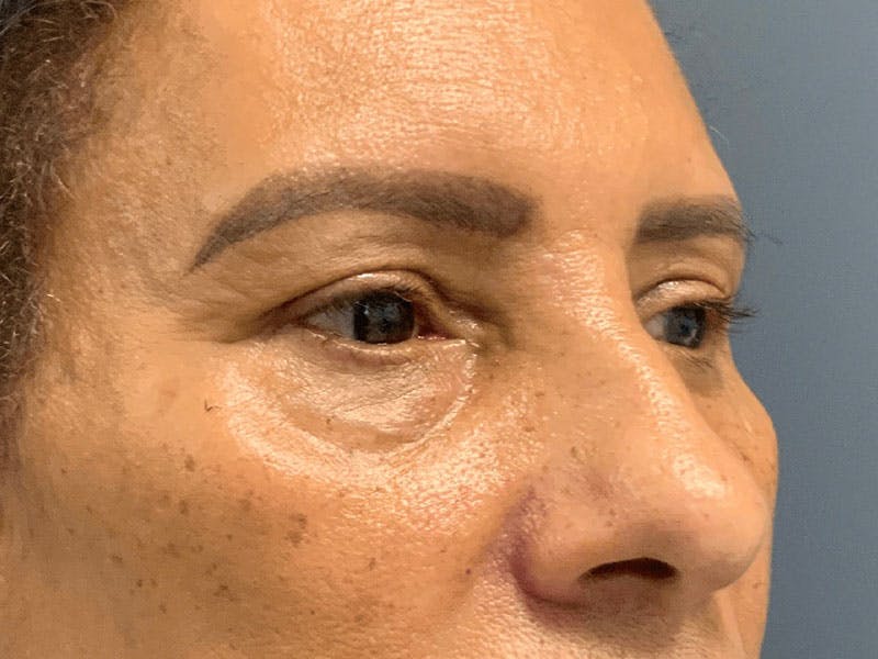 Blepharoplasty Before & After Gallery - Patient 276694 - Image 3
