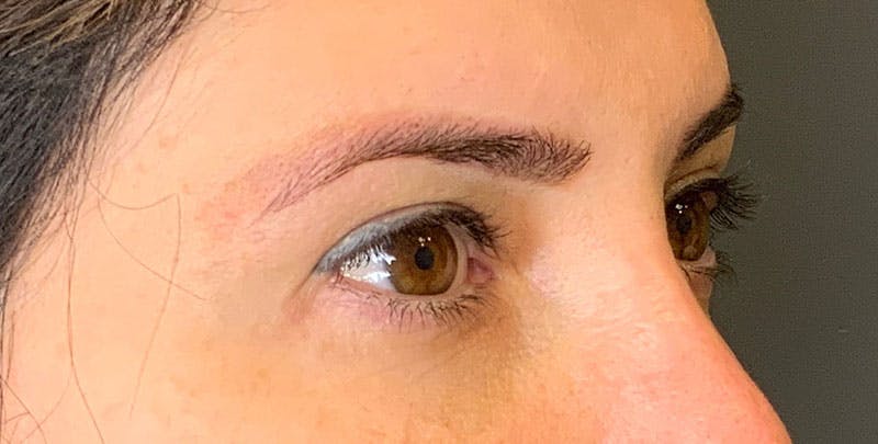 Blepharoplasty Before & After Gallery - Patient 156052 - Image 4