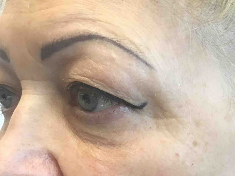 Blepharoplasty Before & After Gallery - Patient 167440 - Image 2