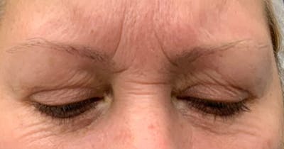 Botox Before & After Gallery - Patient 230320 - Image 1