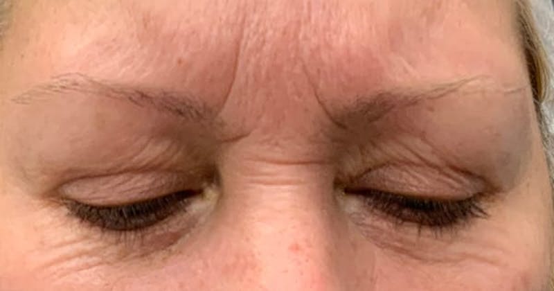 Botox Before & After Gallery - Patient 230320 - Image 1