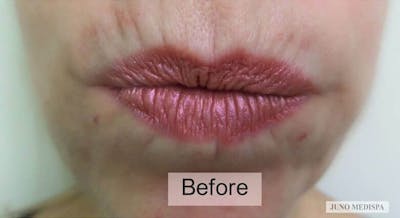 Botox Before & After Gallery - Patient 134549 - Image 1