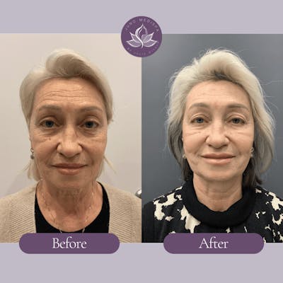 Botox Before & After Gallery - Patient 341932 - Image 1