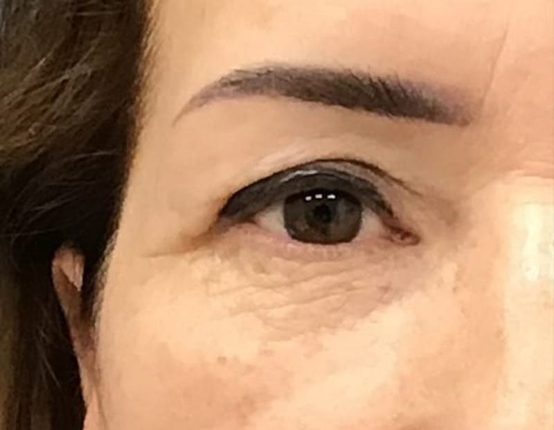 Blepharoplasty Before & After Gallery - Patient 368176 - Image 3