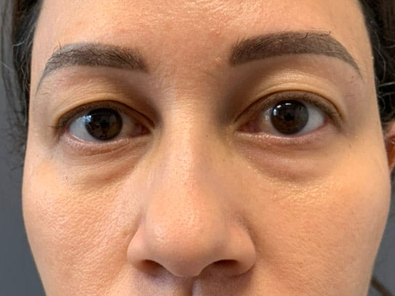 Blepharoplasty Before & After Gallery - Patient 410588 - Image 1