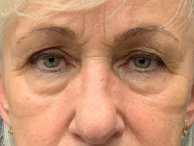 Blepharoplasty Before & After Gallery - Patient 386447 - Image 1