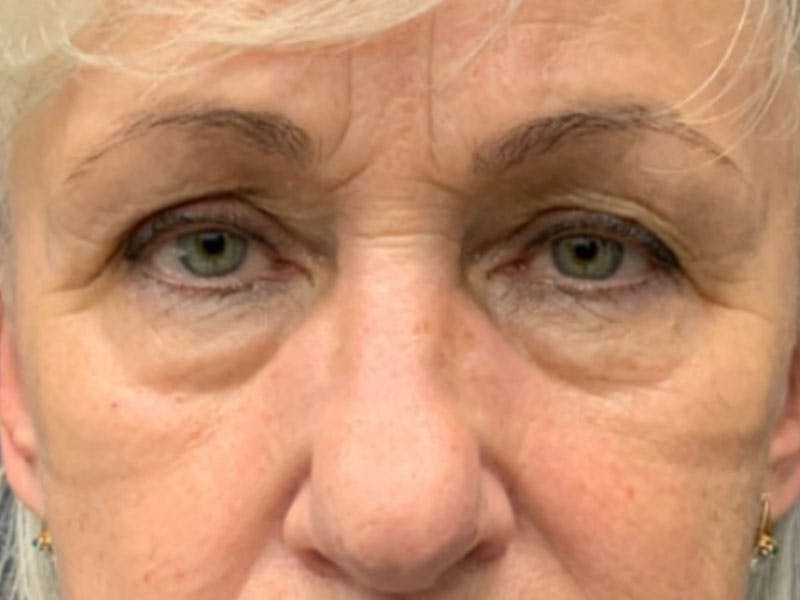 Blepharoplasty Before & After Gallery - Patient 386447 - Image 1