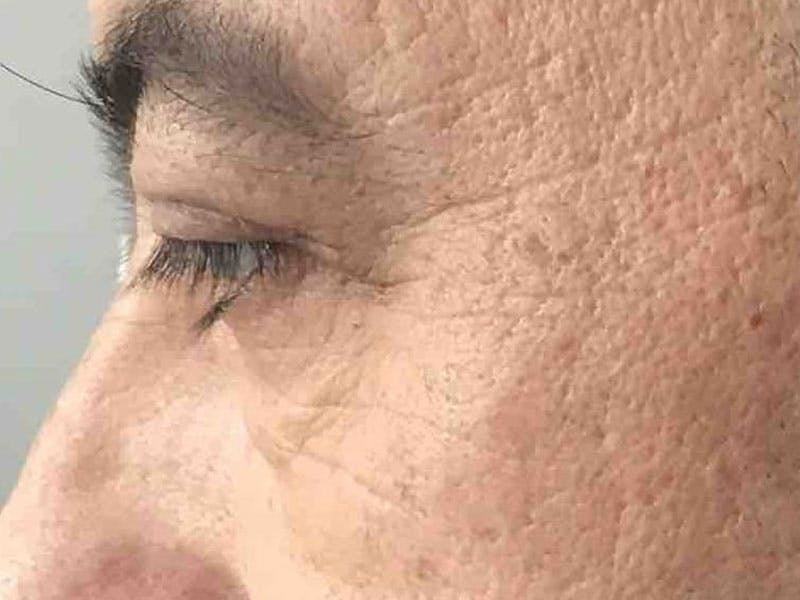 Blepharoplasty Before & After Gallery - Patient 228529 - Image 4