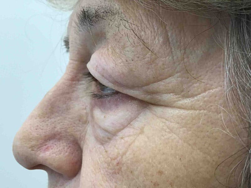 Blepharoplasty Before & After Gallery - Patient 187426 - Image 3