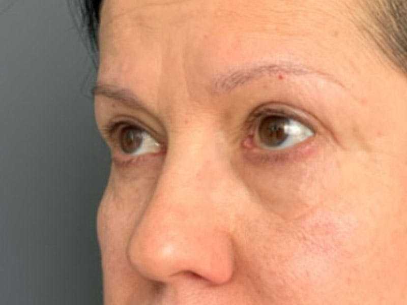 Blepharoplasty Before & After Gallery - Patient 289139 - Image 6