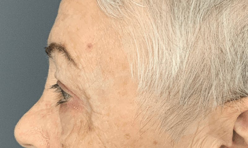 Blepharoplasty Before & After Gallery - Patient 355328 - Image 10