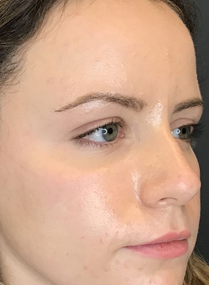 Dermal Fillers Before & After Gallery - Patient 210414 - Image 6