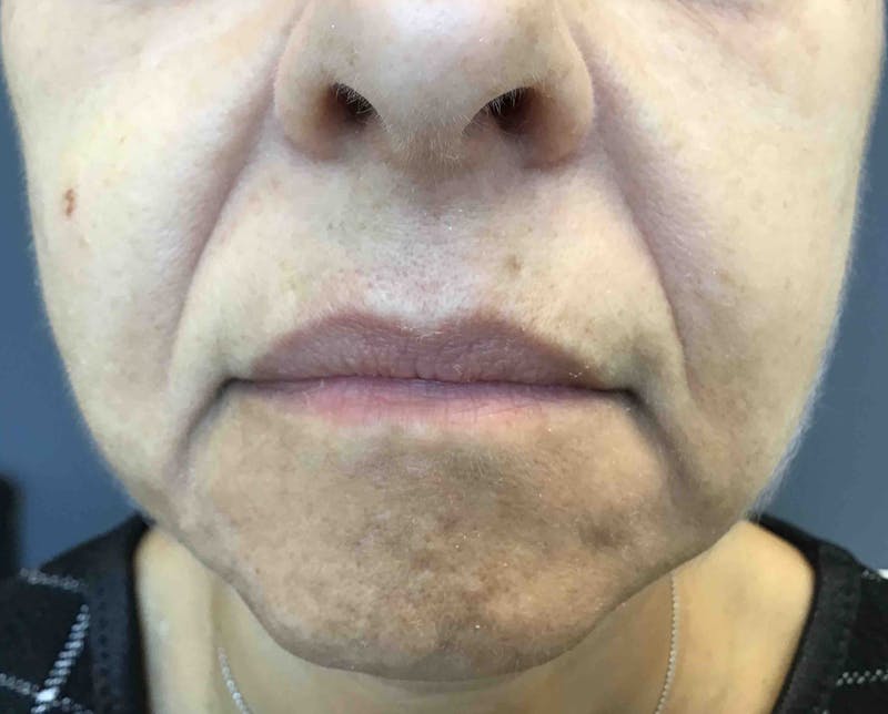 Dermal Fillers Before & After Gallery - Patient 200682 - Image 1