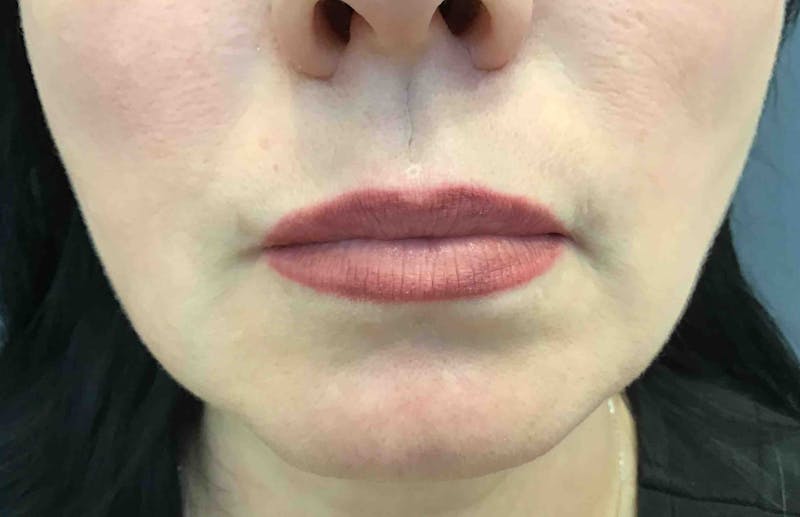 Botox Before & After Gallery - Patient 174355 - Image 2
