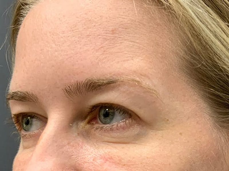 Botox Before & After Gallery - Patient 945116 - Image 10
