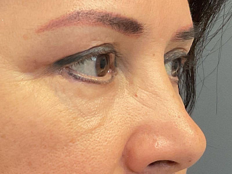 Blepharoplasty Before & After Gallery - Patient 341667 - Image 10
