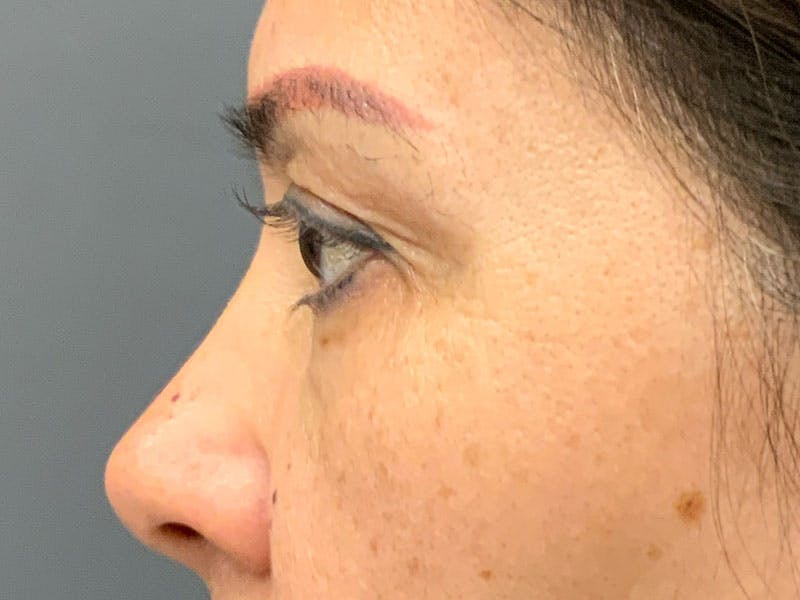 Blepharoplasty Before & After Gallery - Patient 341667 - Image 5