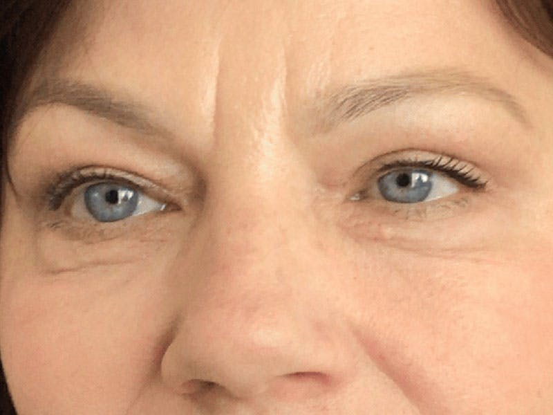 Blepharoplasty Before & After Gallery - Patient 121107 - Image 2