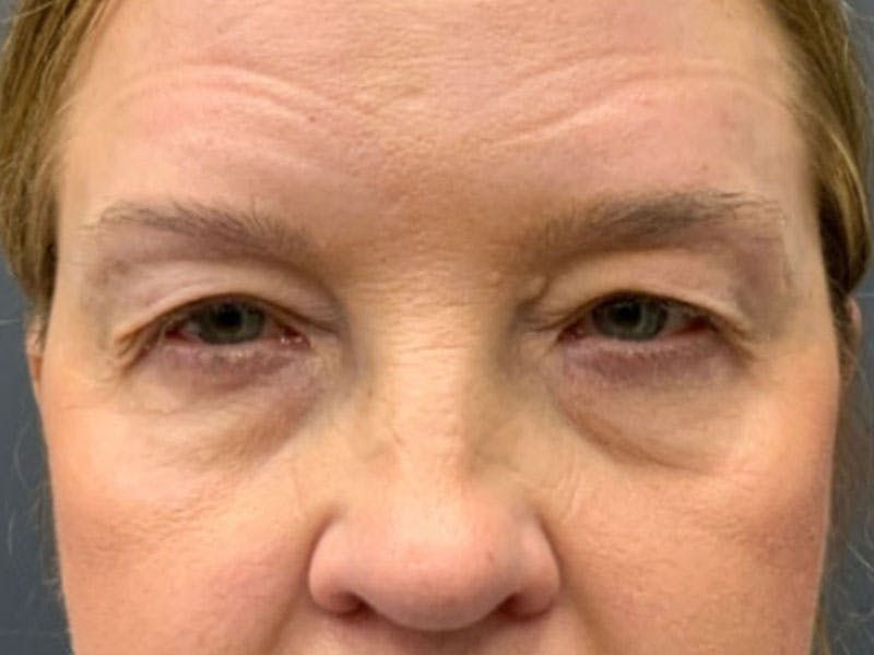 Blepharoplasty Before & After Gallery - Patient 290723 - Image 1