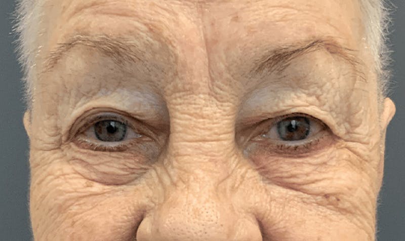 Blepharoplasty Before & After Gallery - Patient 355328 - Image 1