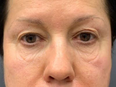 Blepharoplasty Before & After Gallery - Patient 289139 - Image 1
