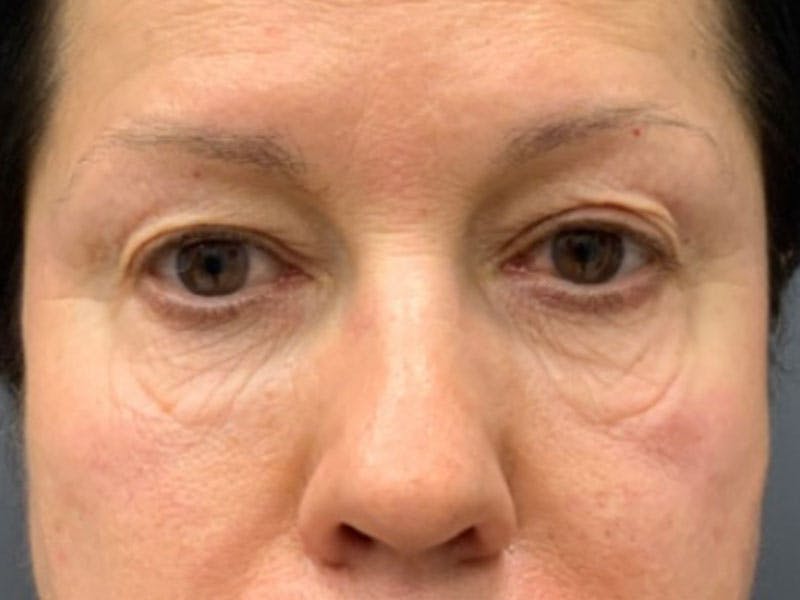 Blepharoplasty Before & After Gallery - Patient 289139 - Image 1