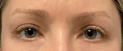 Blepharoplasty Before & After Gallery - Patient 732744 - Image 2