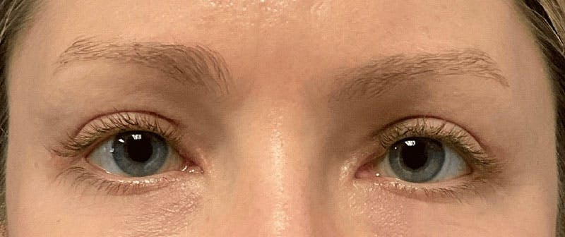 Blepharoplasty Before & After Gallery - Patient 732744 - Image 2