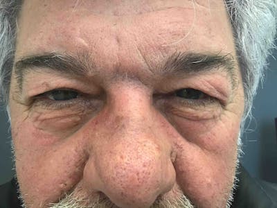 Blepharoplasty Before & After Gallery - Patient 254621 - Image 1