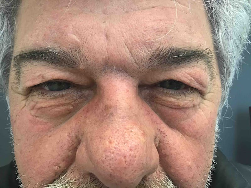 Blepharoplasty Before & After Gallery - Patient 254621 - Image 1