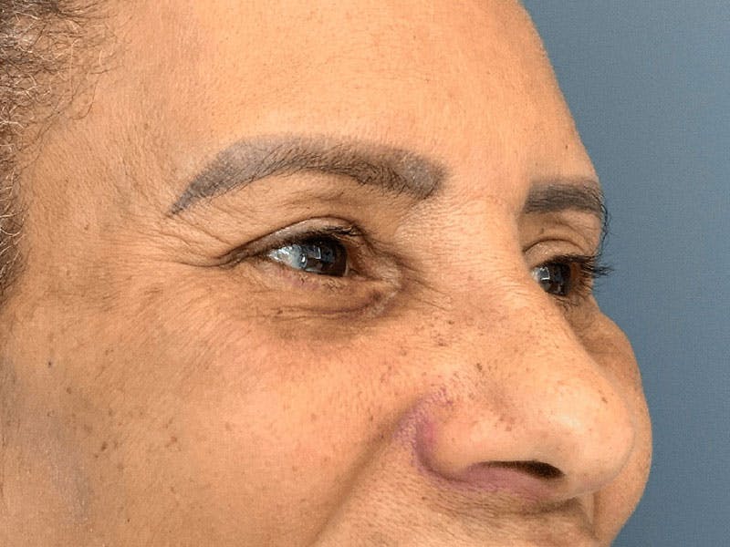 Blepharoplasty Before & After Gallery - Patient 276694 - Image 4