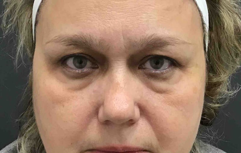 Dermal Fillers Before & After Gallery - Patient 124789 - Image 1