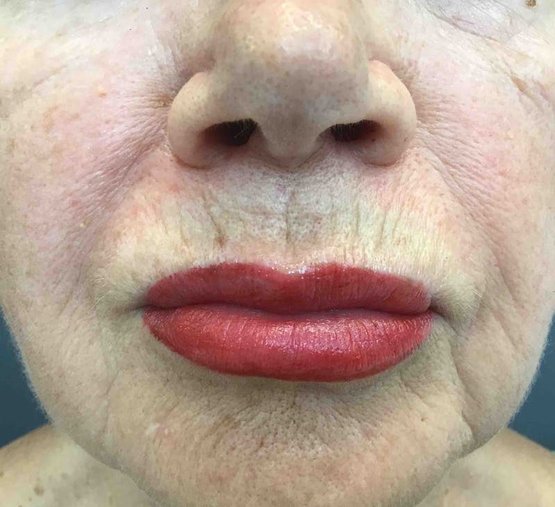 Botox Before & After Gallery - Patient 642585 - Image 2