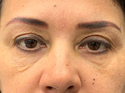 Blepharoplasty Before & After Gallery - Patient 341667 - Image 1