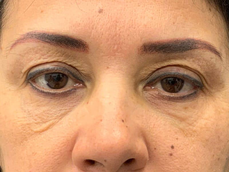 Blepharoplasty Before & After Gallery - Patient 341667 - Image 1